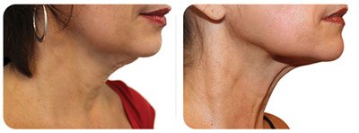 Skin Tightening (Neck)